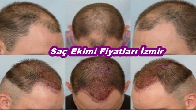 İzmir Saç Ekimi Fiyatları